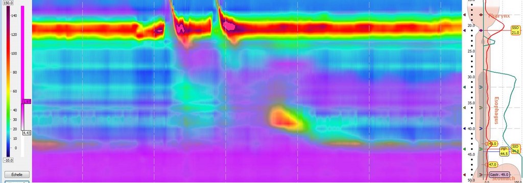 esophageal dysmotility in esophageal atresia