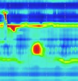 esophageal dysmotility in esophageal atresia